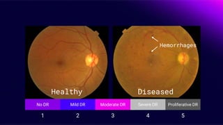 Healthy Diseased
Hemorrhages
Proliferative DRSevere DRModerate DRMild DRNo DR
54321
 