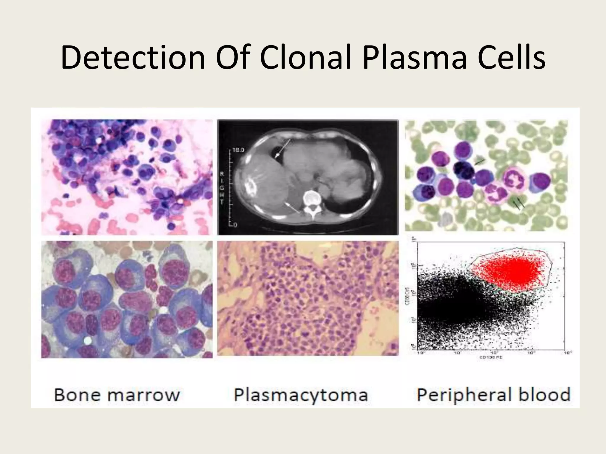 Detection Of Clonal Plasma Cells
 