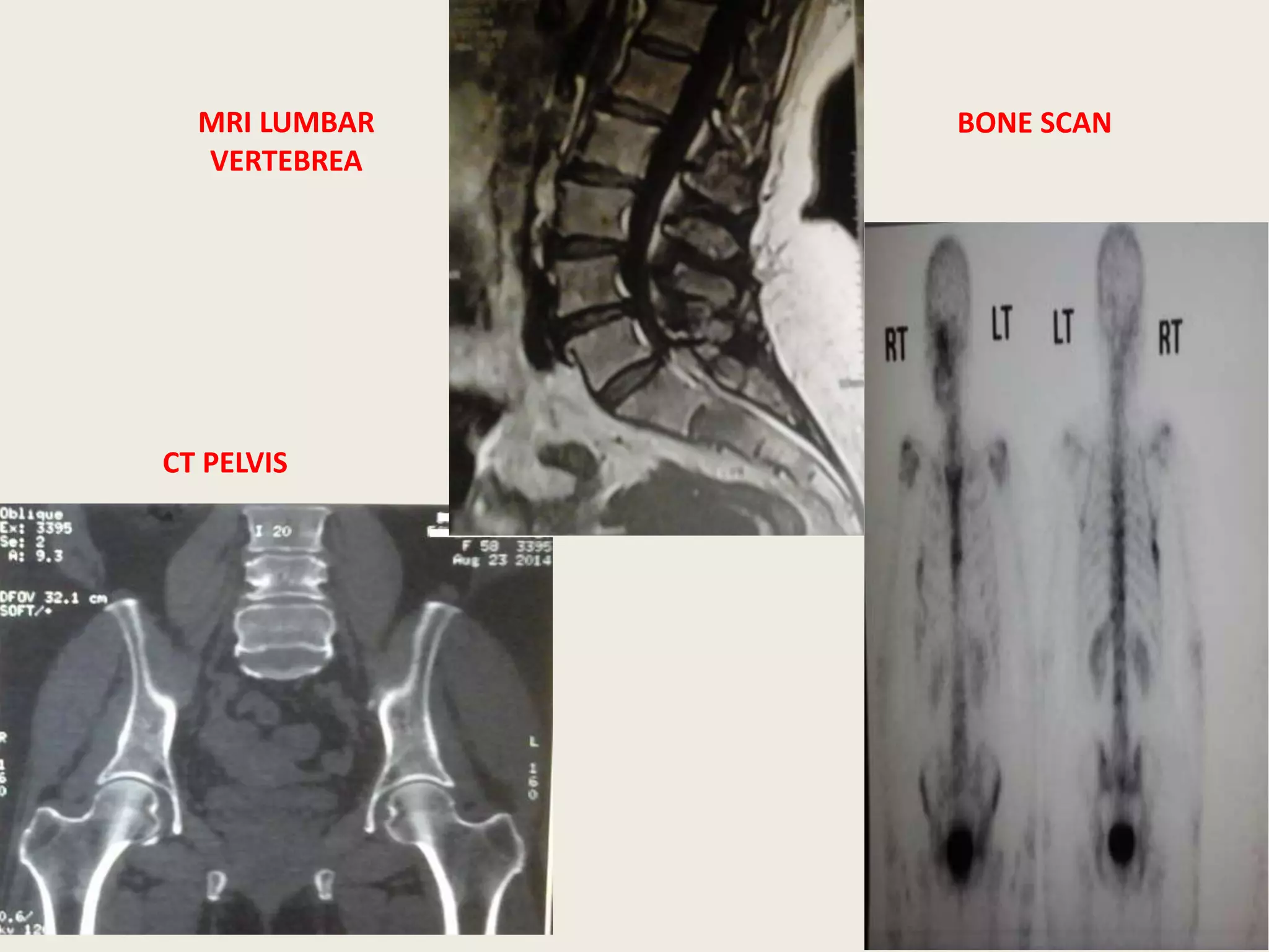 MRI LUMBAR
VERTEBREA
CT PELVIS
BONE SCAN
 