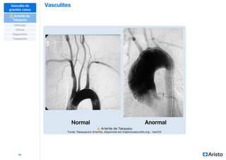 Vasculites
10
Vasculite de
grandes vasos
⚠
⚠ Arterite de
Takayasu
Definição
Diagnóstico
Clínica
Tratamento
⚠ Arterite de Takayasu
Fonte: Takayasus’s Arteritis, disponível em hopkinsvasculitis.org - mar/23
 