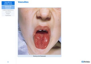Vasculites
14
Vasculite de
médios vasos
Doença de
Kawasaki
Critérios diagnósticos
Imagem
Laboratório
Tratamento
Doença de Kawasaki
 