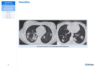 Vasculites
16
Vasculite de
pequenos vasos
⚠
⚠ Granulomatose
com poliangeíte
(GPA/Wegener)
Definição
Diagnóstico
Clínica
Tratamento
⚠ Granulomatose com poliangeíte (GPA/Wegener)
 