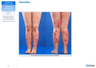Vasculites
21
Vasculite de
pequenos vasos
⚠
⚠ Vasculite por
IgA (púrpura de
Henoch-Schönlein)
Definição
Diagnóstico: clínica,
faixa etária, biópsia
com depósito de IgA
Clínica
Tratamento: corticoide
⚠ Vasculite por IgA (púrpura de Henoch-Schönlein)
 