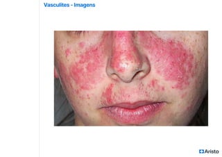 Vasculites - Imagens
 