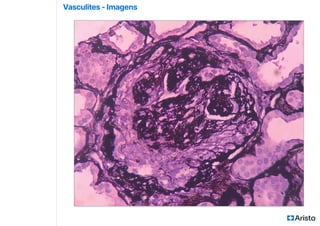 Vasculites - Imagens
 