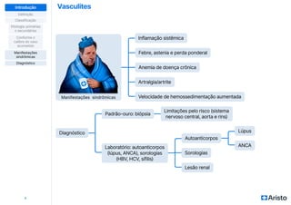 Vasculites
7
Definição
Classificação
Diagnóstico
Manifestações
sindrômicas
Etiologia: primárias
x secundárias
Conforme o
calibre do vaso
acometido
Introdução
Diagnóstico
Padrão-ouro: biópsia
Febre, astenia e perda ponderal
Anemia de doença crônica
Limitações pelo risco (sistema
nervoso central, aorta e rins)
Inflamação sistêmica
Laboratório: autoanticorpos
(lúpus, ANCA), sorologias
(HBV, HCV, sífilis)
Artralgia/artrite
Velocidade de hemossedimentação aumentada
Manifestações sindrômicas
Autoanticorpos
Lúpus
Sorologias
Lesão renal
ANCA
 