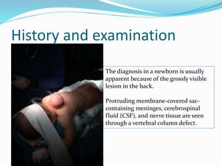History and examination
The diagnosis in a newborn is usually
apparent because of the grossly visible
lesion in the back.
Protruding membrane-covered sac-
containing meninges, cerebrospinal
fluid (CSF), and nerve tissue are seen
through a vertebral column defect.
 