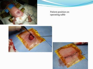 Patient position on
operating table
 