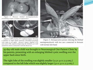 45-day-old male child was brought to Neurosurgical Out-Patient Clinic by
his parents, presenting with an enlarging bilobed cystic swelling over the
upper back since birth.
The right lobe of the swelling was slightly smaller (2.5 x 3.0 x 2.5 cm3 )
compared to the left lobe which was slightly larger (3.0 x 3.0 x 2.5 cm3 )
 