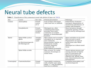 Neural tube defects
 