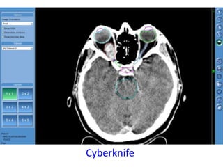 Cyberknife
 
