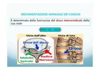 7
È determinata dalla fuoriuscita del disco intervertebrale dalla
sua sede
ERNIA DEL DISCO
MOVIMENTAZIONE	
  MANUALE	
  DEI	
  CARICHI	
  
 