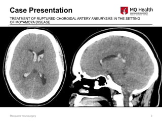 Case Presentation
Macquarie Neurosurgery 3
TREATMENT OF RUPTURED CHOROIDAL ARTERY ANEURYSMS IN THE SETTING
OF MOYAMOYA DISEASE
 