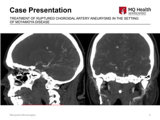 Case Presentation
Macquarie Neurosurgery 4
TREATMENT OF RUPTURED CHOROIDAL ARTERY ANEURYSMS IN THE SETTING
OF MOYAMOYA DISEASE
 