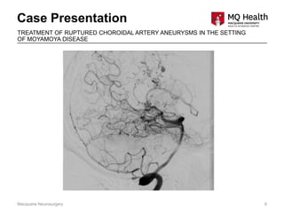 Case Presentation
Macquarie Neurosurgery 6
TREATMENT OF RUPTURED CHOROIDAL ARTERY ANEURYSMS IN THE SETTING
OF MOYAMOYA DISEASE
 