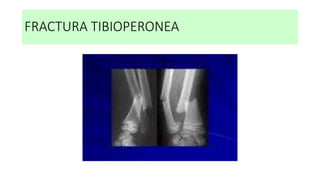 FRACTURA TIBIOPERONEA
 