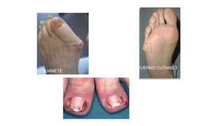 JUANETE
CUERNO CUTANEO
 