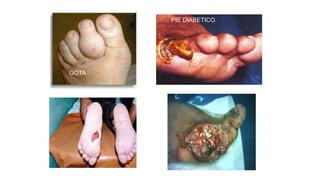 GOTA
PIE DIABETICO
 