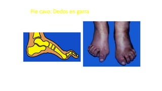 Pie cavo: Dedos en garra
 