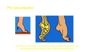 Pie cavo equino
En este caso existe una retracción del tendón de Aquiles, de
las cápsulas posteriores y de la aponeurosis plantar.
 