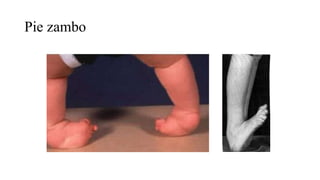 Pie zambo
 