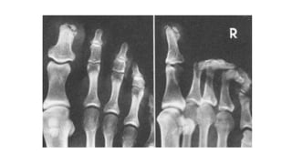 MMII  region glutea.pptx