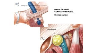 INFUNDÍBULO O
CONDUCTO FEMORAL
Hernias crurales
 