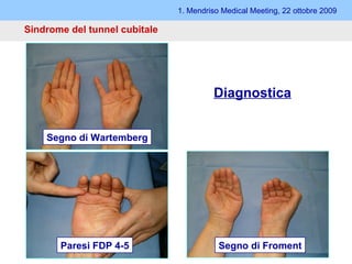 1. Mendriso Medical Meeting, 22 ottobre 2009 Sindrome del tunnel cubitale Diagnostica Segno di Wartemberg Segno di Froment Paresi FDP 4-5 