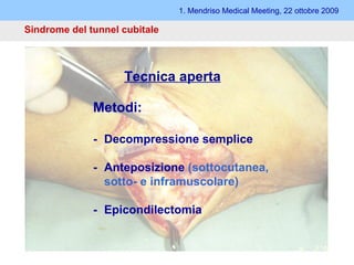 1. Mendriso Medical Meeting, 22 ottobre 2009 Sindrome del tunnel cubitale   Tecnica aperta Metodi: - Decompressione semplice - Anteposizione  (sottocutanea, sotto- e inframuscolare) - Epicondilectomia 