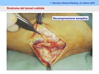 1. Mendriso Medical Meeting, 22 ottobre 2009 Sindrome del tunnel cubitale   Tecnica aperta Metodi: - Decompressione semplice - Anteposizione  (sottocutanea, sotto- e inframuscolare) - Epicondilectomia Decompressione semplice 