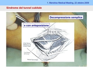 1. Mendriso Medical Meeting, 22 ottobre 2009 Sindrome del tunnel cubitale   Tecnica aperta Metodi: - Decompressione semplice - Anteposizione  (sottocutanea, sotto- e inframuscolare) - Epicondilectomia Decompressione semplice e con anteposizione 