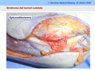 1. Mendriso Medical Meeting, 22 ottobre 2009 Sindrome del tunnel cubitale   Tecnica aperta Metodi: - Decompressione semplice - Anteposizione  (sottocutanea, sotto- e inframuscolare) - Epicondilectomia Decompressione semplice e con anteposizione Epicondilectomia 