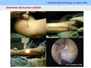 1. Mendriso Medical Meeting, 22 ottobre 2009 Sindrome del tunnel cubitale Tecnica endoscopica Dr. R. Hoffmann, 2005 