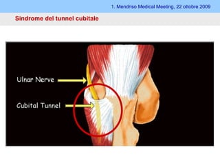 Sindrome del tunnel cubitale 1. Mendriso Medical Meeting, 22 ottobre 2009 M. anconeo-epitrocleare 