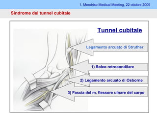 Sindrome del tunnel cubitale 1. Mendriso Medical Meeting, 22 ottobre 2009 Solco retrocondilare Legamento arcuato di Osborne Legamento arcuato di Struther Fascia del m. flessore ulnare del carpo Tunnel cubitale 3) Fascia del m. flessore ulnare del carpo Legamento arcuato di Struther 2) Legamento arcuato di Osborne 1) Solco retrocondilare 