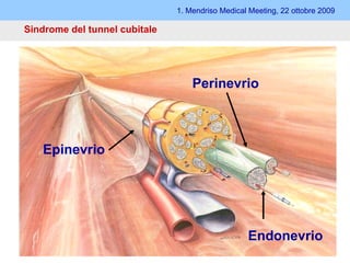 Sindrome del tunnel cubitale 1. Mendriso Medical Meeting, 22 ottobre 2009 Sintomatologia Sintomi irritativi formicolii intorpidimento dolore Sintomi deficitari    sensibilità    forza atrofia muscolare Epinevrio Perinevrio Endonevrio 