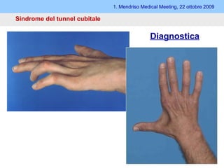 1. Mendriso Medical Meeting, 22 ottobre 2009 Sindrome del tunnel cubitale Diagnostica 