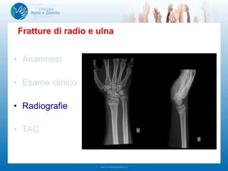 • Anamnesi
• Esame clinico
• Radiografie
• TAC
Fratture di radio e ulna
-Deformazioni
-Mobilità dita e polso
-Sensibilità periferica (nervo mediano)
-Circolazione periferica
-…
-Gomito!!!
 