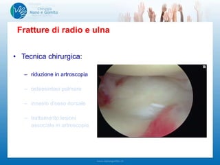 • Tecnica chirurgica:
– riduzione in artroscopia
– osteosintesi palmare
– innesto d'osso dorsale
– trattamento lesioni
associate in artroscopia
Fratture di radio e ulna
 