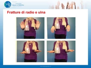 Fratture di radio e ulna
 