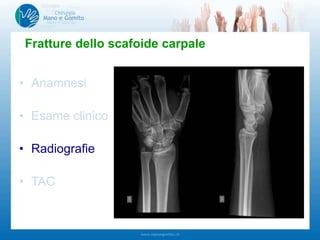 • Anamnesi
• Esame clinico
• Radiografie
• TAC
Fratture dello scafoide carpale
-Dolenzia tabacchiera anatomica
-Dolenzia tubercolo scafoide
-Dolenzia tra scafoide e semilunare
-Mobilità pollice e polso
 