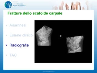 • Anamnesi
• Esame clinico
• Radiografie
• TAC
Fratture dello scafoide carpale
-Dolenzia tabacchiera anatomica
-Dolenzia tubercolo scafoide
-Dolenzia tra scafoide e semilunare
-Mobilità pollice e polso
 