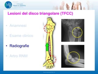 • Anamnesi
• Esame clinico
• Radiografie
• Artro RNM
Lesioni del disco triangolare (TFCC)
 
