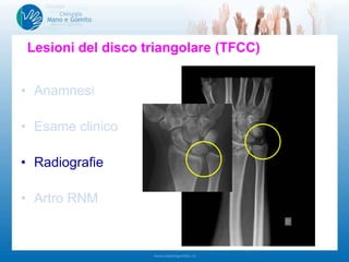 • Anamnesi
• Esame clinico
• Radiografie
• Artro RNM
Lesioni del disco triangolare (TFCC)
 