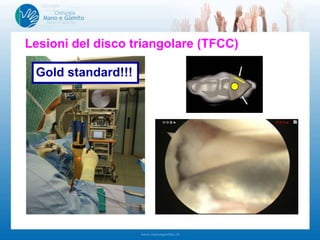 Lesioni del disco triangolare (TFCC)
Gold standard!!!
 