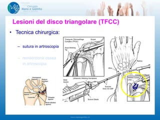 • Tecnica chirurgica:
– sutura in artroscopia
– reinserzione ossea
in artroscopia
Lesioni del disco triangolare (TFCC)Lesioni del disco triangolare (TFCC)
 