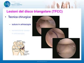 Lesioni del disco triangolare (TFCC)
• Tecnica chirurgica:
– sutura in artroscopia
– reinserzione ossea
in artroscopia
 