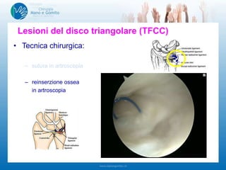 Lesioni del disco triangolare (TFCC)
• Tecnica chirurgica:
– sutura in artroscopia
– reinserzione ossea
in artroscopia
 