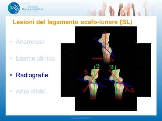 • Anamnesi
• Esame clinico
• Radiografie
• Artro RNM
Lesioni del legamento scafo-lunare (SL)
-Dolore tra scafoide e semilunare
-Test di Watson
-Instabilità medio carpica
-…
-Polso controlaterale!!!
scafoide
semilunare
 