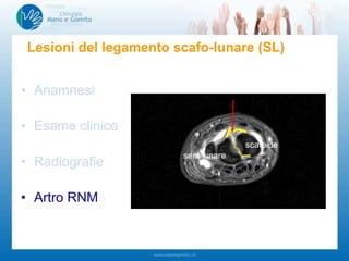 • Anamnesi
• Esame clinico
• Radiografie
• Artro RNM
Lesioni del legamento scafo-lunare (SL)
-Dolore tra scafoide e semilunare
-Test di Watson
-Instabilità medio carpica
-…
-Polso controlaterale!!!
scafoide
semilunare
 
